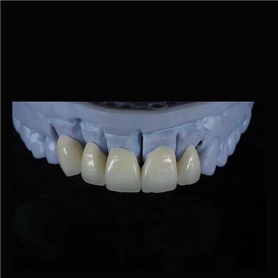 Corona de Zirconia Estética y Fuerte