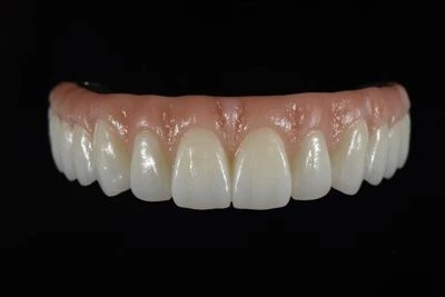 Puente All-on-X Zirconia diseñado digitalmente