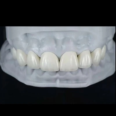 Carillas E.max para cierre de diastema