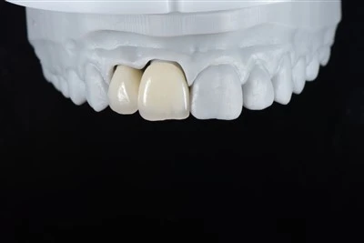 Corona E-max presionada